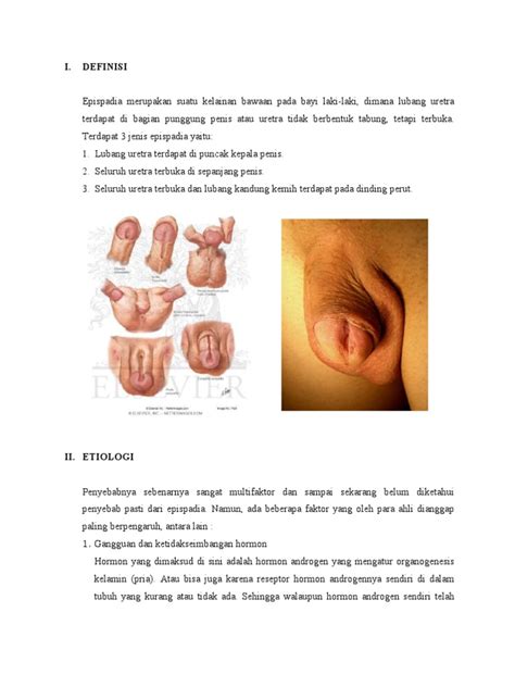 Hypospadias refers to a birth defect of the male urethra where the urinary opening is not on the head of the penis. Epispadia