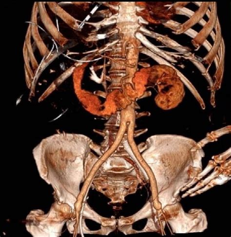 This occurs in up to 40% of patients with abscesses. Secondary aortoduodenal fistula and the unrecognised ...