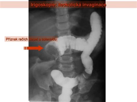 Je jedním ze tří největších v české republice s největším počtem odoperovaných pacientů. PPT - RTG hrudníku: pleurální výpotek vpravo PowerPoint ...