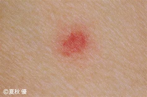 虫刺され 赤く腫れる - 蚊に刺されて赤く腫れてしまったと皮膚 ...