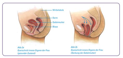 Die meinungen in meinem ärztekreis sind unterschiedlich. Therapie bei Beckenbodensenkung - Dr Bumbu Frauenarzt ...