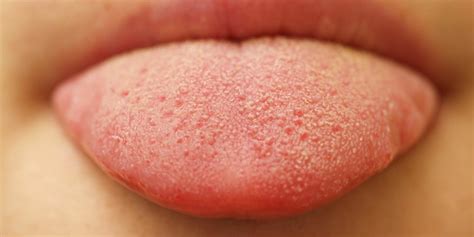 260 x 258 jpeg 60 кб. What Is Oral Thrush and Who Is at Risk for Getting It ...