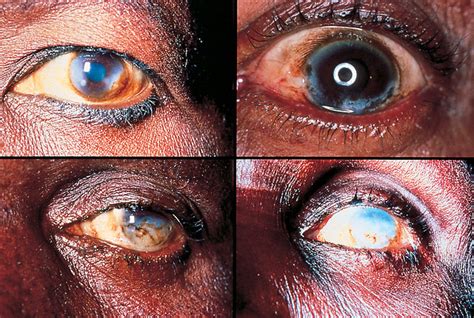 The world health organization has set a goal to eliminate river blindness, a neglected tropical disease found mostly in. ONCHOCERCIASIS (River Blindness)