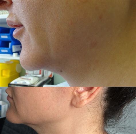 It can take as long as 4 days to get the funds after closing in a dry state. Laser - Liposculpture | Laurea Cosmetic Surgery Sydney