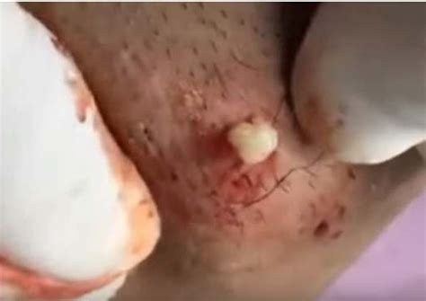 As the name suggests, ingrown hair cysts start out as hairs that get trapped in the skin. how long do ingrown hairs last | New Pimple Popping Videos