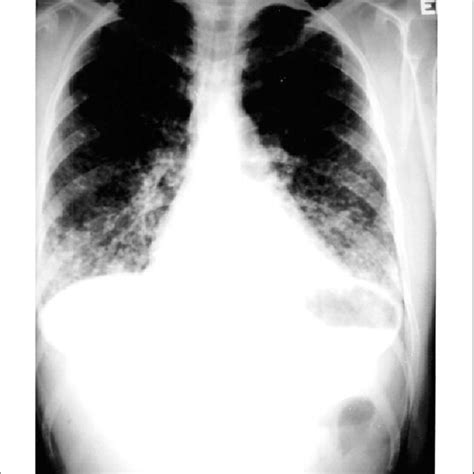 Although less common, short transverse myelitis is seen in 14.5% of cases 11. Neurological complications associated with chickenpox and ...