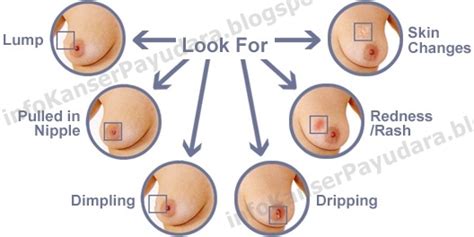 Early signs of inflammatory breast cancer resemble an infection or skin rash. InfoKanserPayudara: October 2012