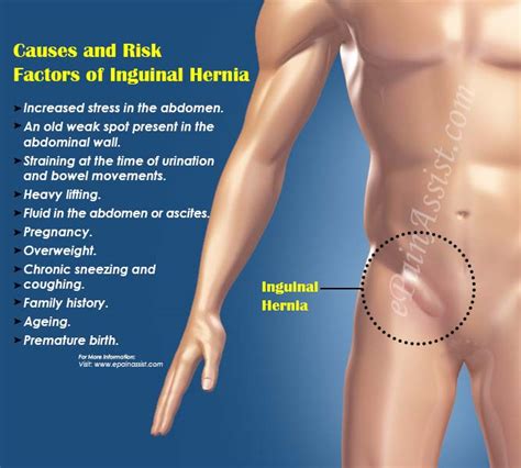 You may have any of the following: Hernia Surgery Houston | Hernia Center Advanced Houston Surgical