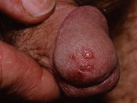 Herpes simplex is a common viral infection. Herpes Simplex Virus Type 1 (HSV1, fever blisters, cold ...