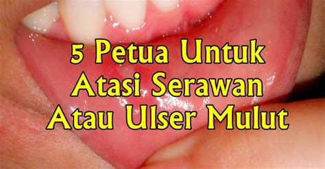 Ulser di bahagian mulut mungkin perkara biasa bagi sesetengah orang. Petua Merawat Ulser Mulut Dengan Cepat | Vitamin Semulajadi