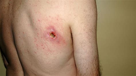 Jump to navigation jump to search. Australia seeks help in halting flesh-eating Buruli ulcer ...