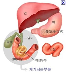 수술 후 협착, 종양 등의 원인에 의해 완전 혹은 불완전 협착. 【췌장암】췌장암수술/휘플씨/췌전절제술/위위부 췌장 절제술 ...