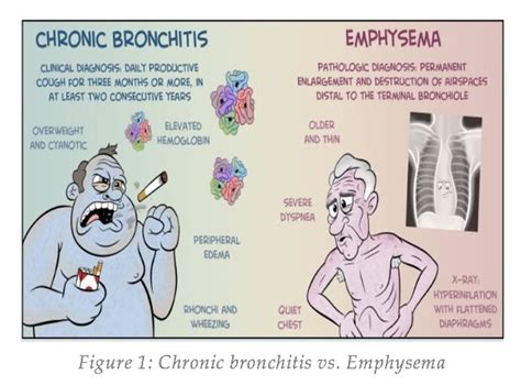 Risk factors for chronic bronchitis include continuous attacks of acute bronchitis, weak immune system, irritants, and polluted air. #LetMedUT hashtag on Twitter