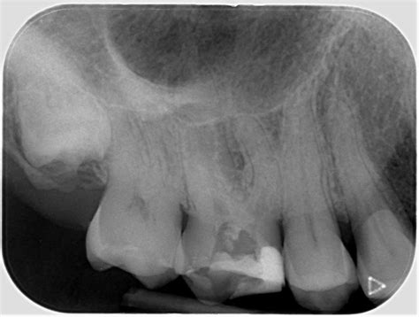 We did not find results for: Problem solving: managing ledges during root canal ...