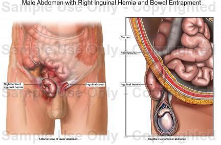 The organs aren't really on your back they are situated between the framework of your body on the right side you have the the right lung, the liver. Male Abdomen with Right Inguinal Hernia and Bowel ...