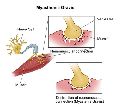 It's caused by a breakdown in the normal communication between nerves and muscles. Myasthenia Gravis | Bone and Spine