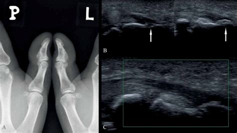 Plantar flexion is a term that describes the motion of pointing the foot downwards. Bilateral enthesopathy of the flexor pollicis longus tendons (arrows),... | Download Scientific ...