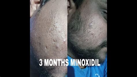 Look no further than minoxidil for the beard. MINOXIDIL BEARD । 3 MONTHS JOURNEY ।। BEFORE AND AFTER - YouTube