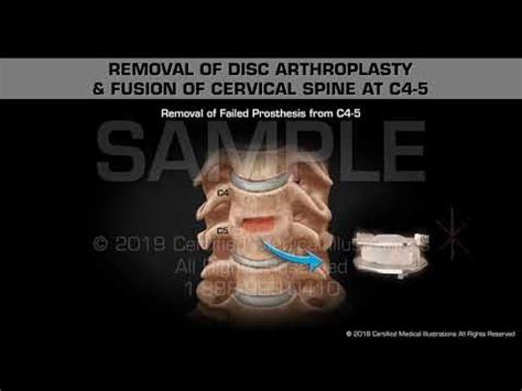 Free trial available for new and eligible returning subscribers. This animation depicts a removal of disc arthroplasty and ...