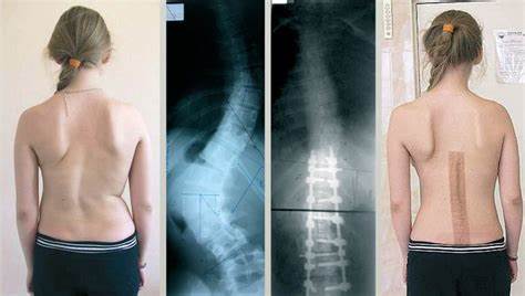 Ожирение 3 степени у женщин лечение как похудеть препараты