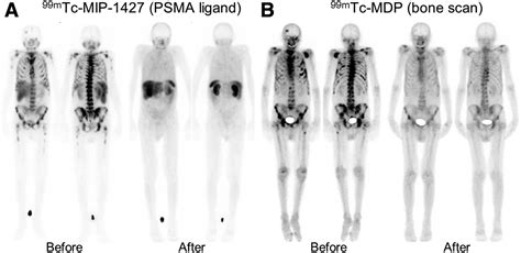 It is a type of precision cancer treatment combining a. Targeted α-Therapy of Metastatic Castration-Resistant ...