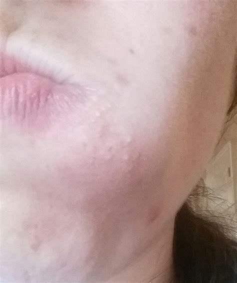 Canker sores look like ulcers with a grey, yellow, or white center and a flat, red border. Acne Nothing seems to get rid of little bumps around ...