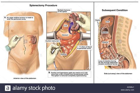L'opération et le retour à domicile se font le. Milz-Operation mit Komplikationen der Incisional Hernie ...