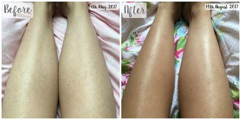 Check spelling or type a new query. Tria Hair Removal Laser 4X | G Beauty