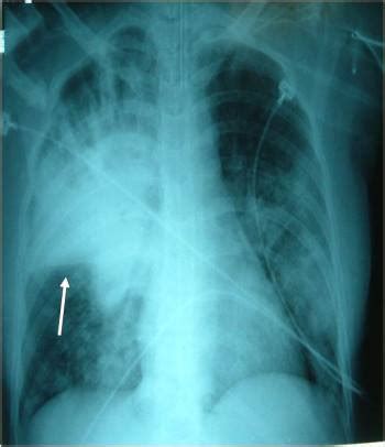 Tous les cas de légionellose diagnostiqués doivent être déclarés à la fois par les médecins et les biologistes aux autorités. Pneumonie contractée en ville - Troubles pulmonaires ...