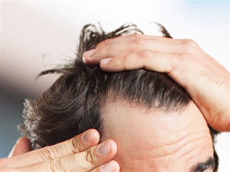 The hair loss shampoo also provides a deep, rejuvenating wash. MEN & HAIR LOSS: CAUSES, TREATMENTS AND SOLUTIONS