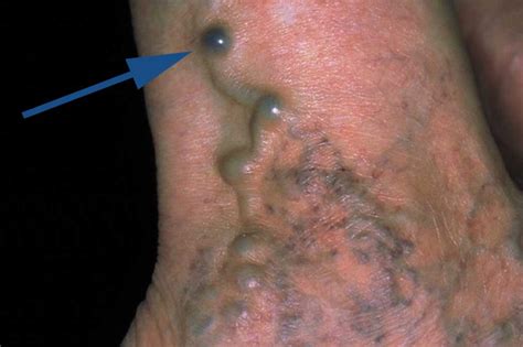 Dann ist das ein hinweis auf ein blutgerinnsel unter der haut. Thrombophlebitis Blutungen