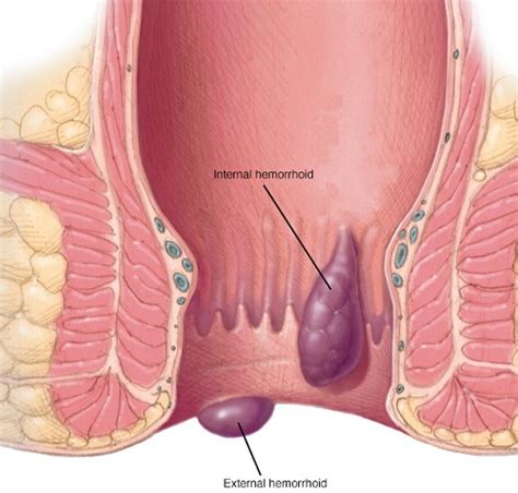 How do we know they're the hottest? How to Use Essential Oils to Treat Hemorrhoids | MD-Health.com