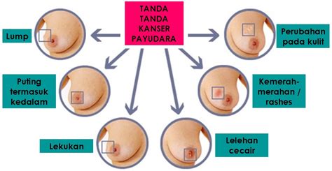 Payudara Berdarah Dan Bernanah. Tanda-tanda Kanser ...