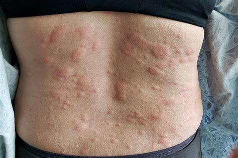 They may also burn or sting. Home Remedies for Hives: What Really Helps? | Women's Alphabet