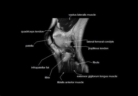 Click on the links to show each structure. mri knee anatomy | knee sagittal anatomy | free cross sectional anatomy | | Knee mri, Anatomy ...