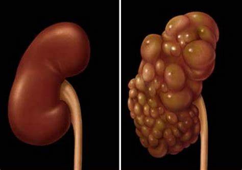 Диет при кистах печени