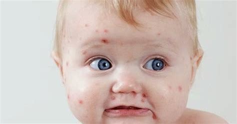 The rash generally takes the form of elevated reddish spots with no visible fluid inside them. Petua Kurangkan Kegatalan Dan Ruam Chicken Pox Dan Cara ...