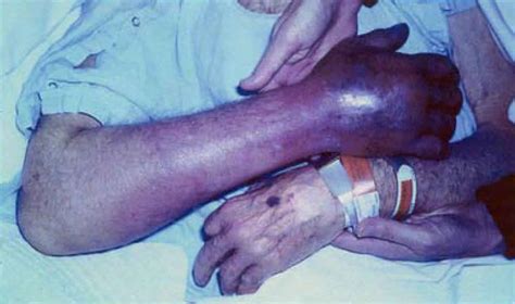 Purple glove syndrome, causes, symptoms, diagnosis & treatment