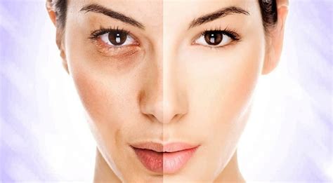 A skin whitening treatment works by reducing the pigment melanin in your skin by several possible mechanisms as discussed earlier. Best Skin Lightening Pills - Supplements for Black People ...