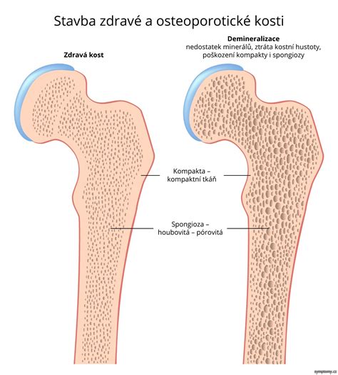 Kdo je ohrožen cystickou fibrózou? Denzita jater články a rady