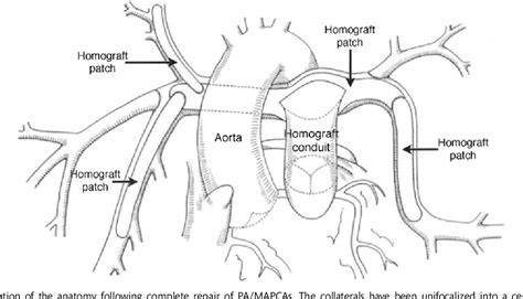 A collateral relative a collateral inherited the estate. Figure 3 from Surgical outcomes for patients with ...