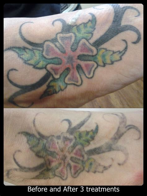 Black has the unique property of being able to get quickly removed with almost any laser wavelength. This very bold, vibrant colored tattoo is responding well ...