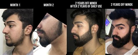 And then there's the 10% minoxidil solution, the most powerful of all, or at least one would think. Minoxidil Before And After Beard Result - Minoxidil For ...