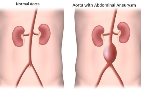 Aneurisma adalah pelebaran pembuluh darah yang tidak normal, sebagai tingkat keparahan aneurisma diukur dengan ukuran dan lokasi di mana dilatasi terjadi, yang dapat. Aneurisma Aorta : Penyebab - Gejala dan Penanganan - IDN Medis