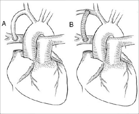 Tetralogy of fallot accounts for 5 to 10% of all congenital heart disease and has an estimated prevalence of 1 in 2000 births 10. Tetralogy of Fallot- Pathophysiology -Managment ...