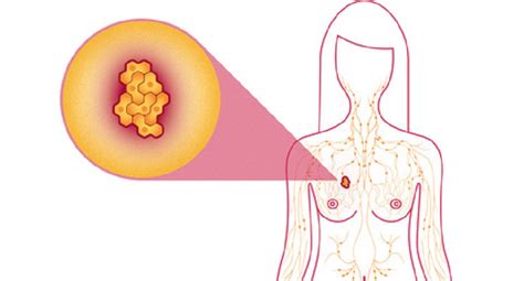 Lymph node status indicates whether any breast cancer cells. Breast Cancer, Symptoms, Types, Causes, Treatment and ...