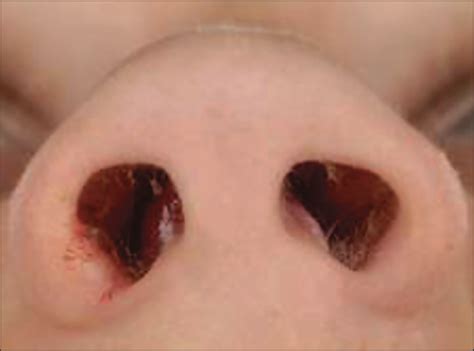 The nasal septum is composed of both bone and cartilage and extends from the nostrils to the back of the nose. Nasal Septal Abscess in Children: Reconstruction With ...