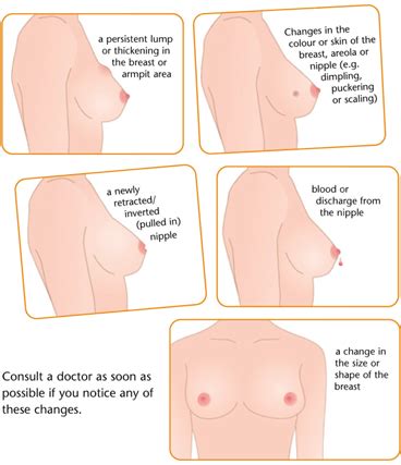 Most people who have breast cancer symptoms and signs will initially notice only one or two, and the presence of these symptoms and signs do not automatically mean that you have breast cancer. Altrol™ Tablets (Anastrozole)