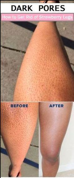 The condition is a benign and chronic skin condition.it happens more in people with dry skin. Use this recipe to get rid of strawberry leggs #skincare ...