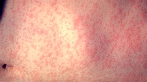 Many types, from may manufacturers, at different times, for different people and in different who else had heart complications from covid vaccine?question (self.covidvaccinated). Six things to know about measles (and the measles vaccine ...